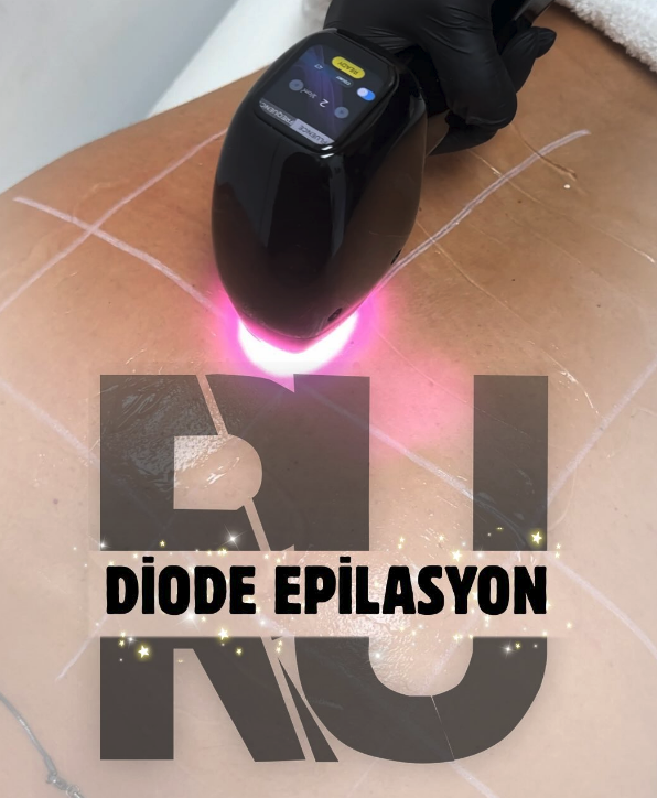 Diode Epilasyon
